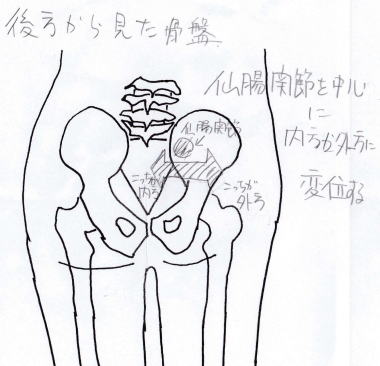 骨盤のズレ方後ろ面